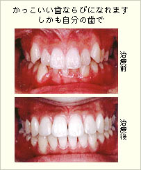 矯正治療前と治療後の歯ならび比較写真