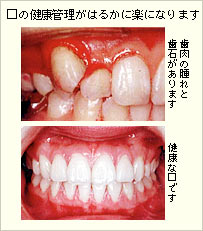 矯正治療前の治歯肉の腫れと歯石がある口と治療後の健康な口の比較写真