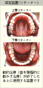 動的治療(歯を積極的に動かす治療）が終了したあとに使用するリテーナー（保定装置）の写真