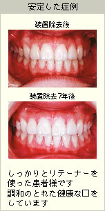 安定した症例の写真：しっかりとリテーナーを使った患者様の調和のとれた健康な口(装置除去7年後)